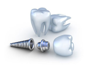 Dental implants prevent bone loss